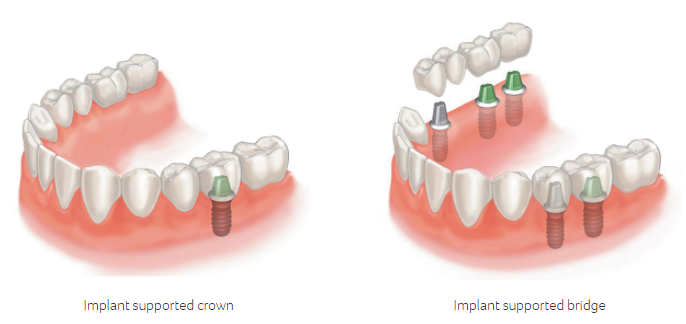 dental implants near me crown and bridge example