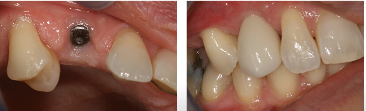 dental implants single tooth implant before and after example in Greenwich